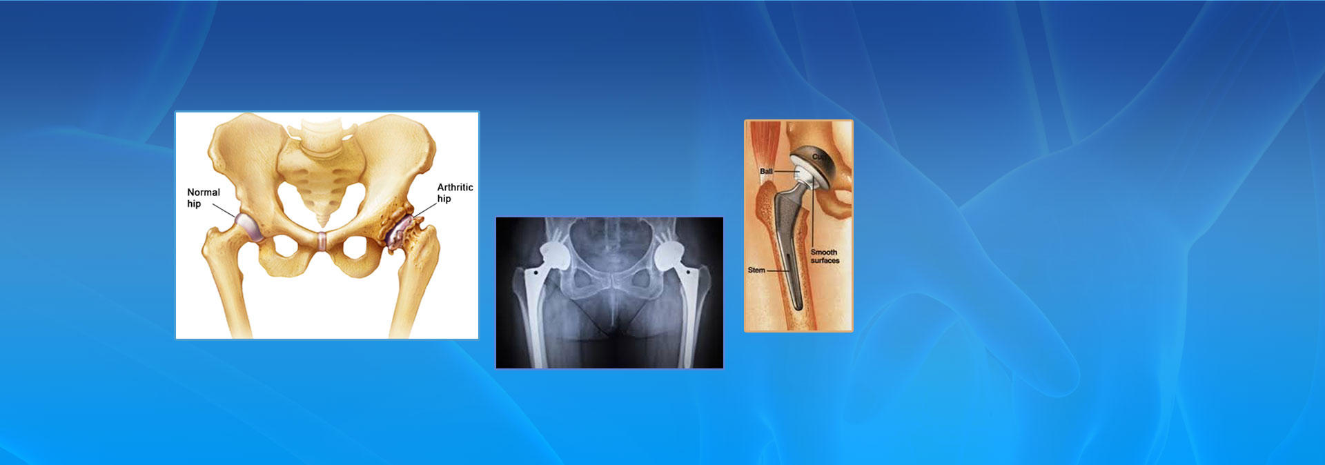 total hip replacement image