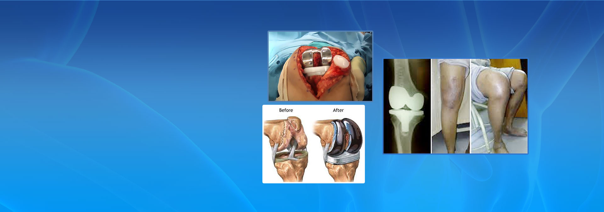 knee replacement image
