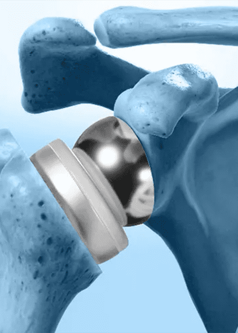 Shoulder Replacement